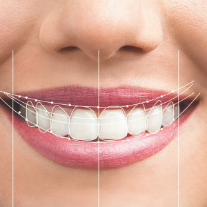 Digitális mosolytervezés, aminek te is aktív részese lehetsz a Hollán Dentál rendelőjében
