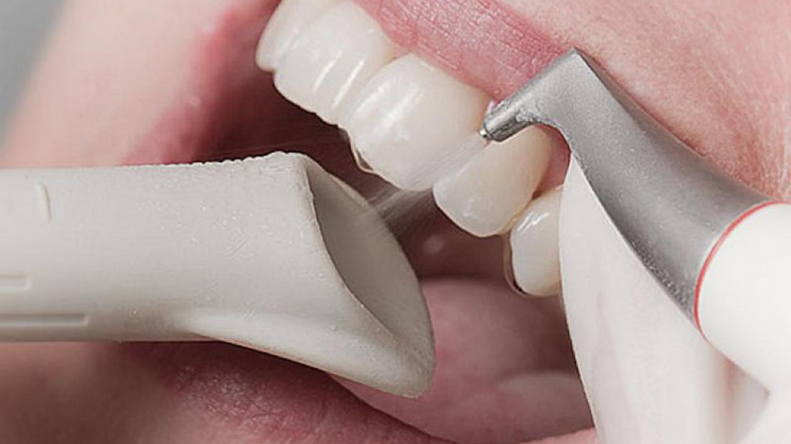 Tiszta és ragyogó fogsor Air flow fogtisztítással